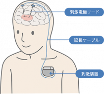 日本定位・機能神経外科学会ＨＰより