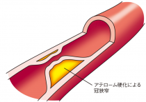 ＤＥＳの留置が必要な冠動脈狭窄のイメージ（大阪医療センターHPより）